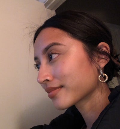 After non-surgical nose job