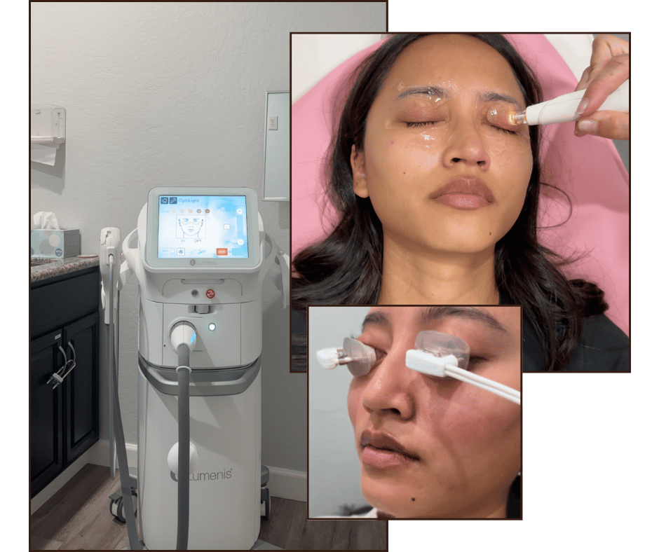 ipl and tear care treatment